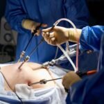 Laparoscopic Gastric Bypass 2 Scaled 1 150x150