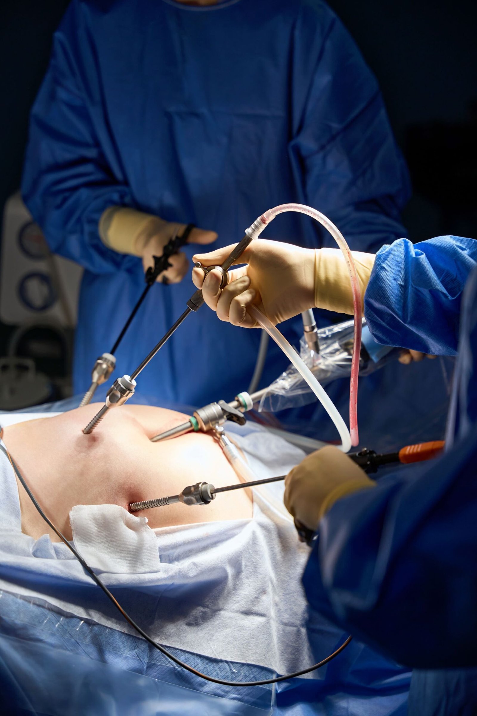 Laparoscopic Gastric Bypass 2 Scaled 1